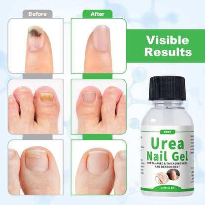 ZOXY Urea Nail Gel 40% – Softens Thick Nails & Discoloration | Fast-Absorbing Nail Restoration
